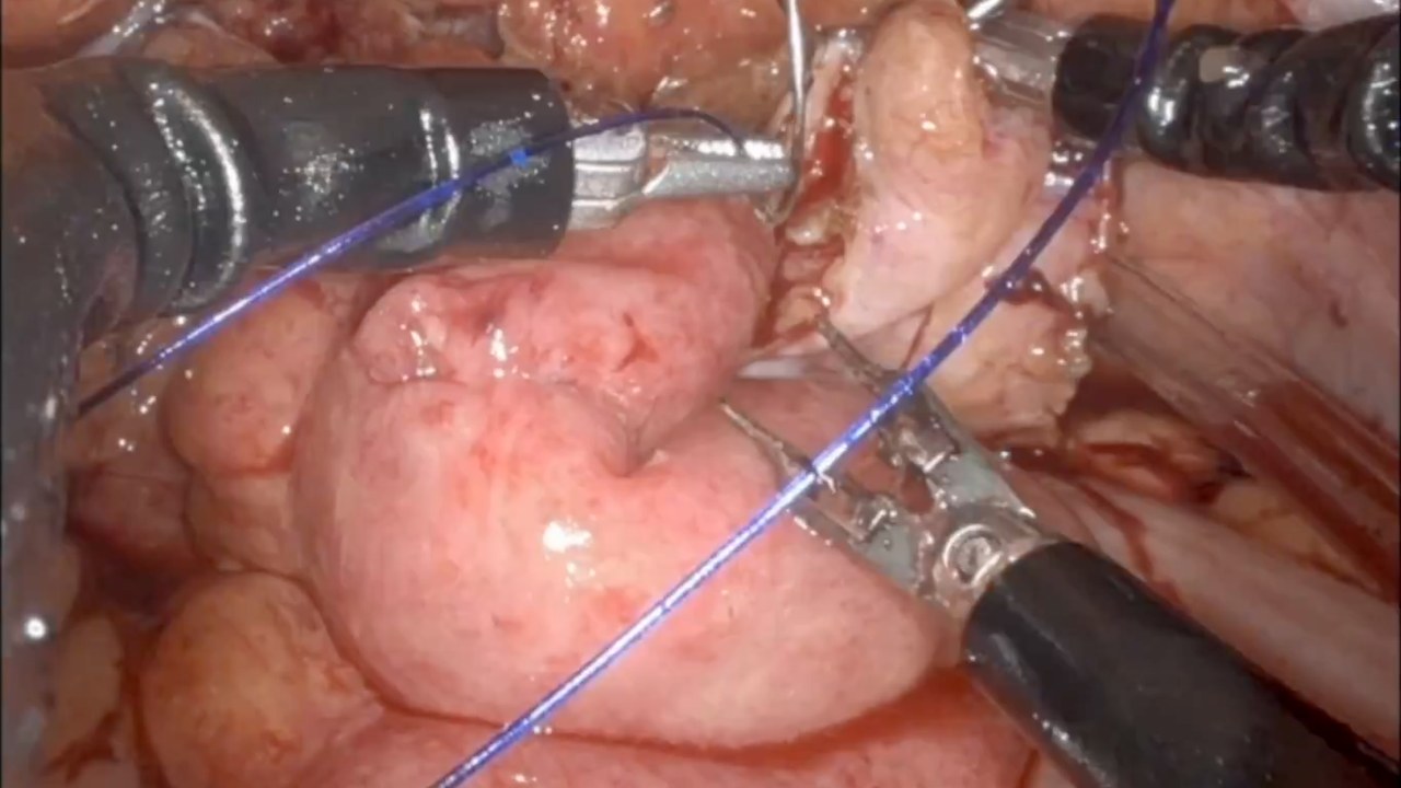 Robotic console view: a pink loop of small bowel held between two instruments, a blue suture running through its edge, over red pelvic tissue.