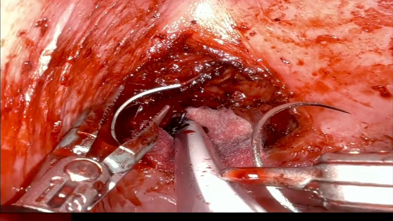Robotic console view in a narrow red field: two needle drivers holding curved needles and a dark suture at a tissue edge in the depth, pink tissue below.