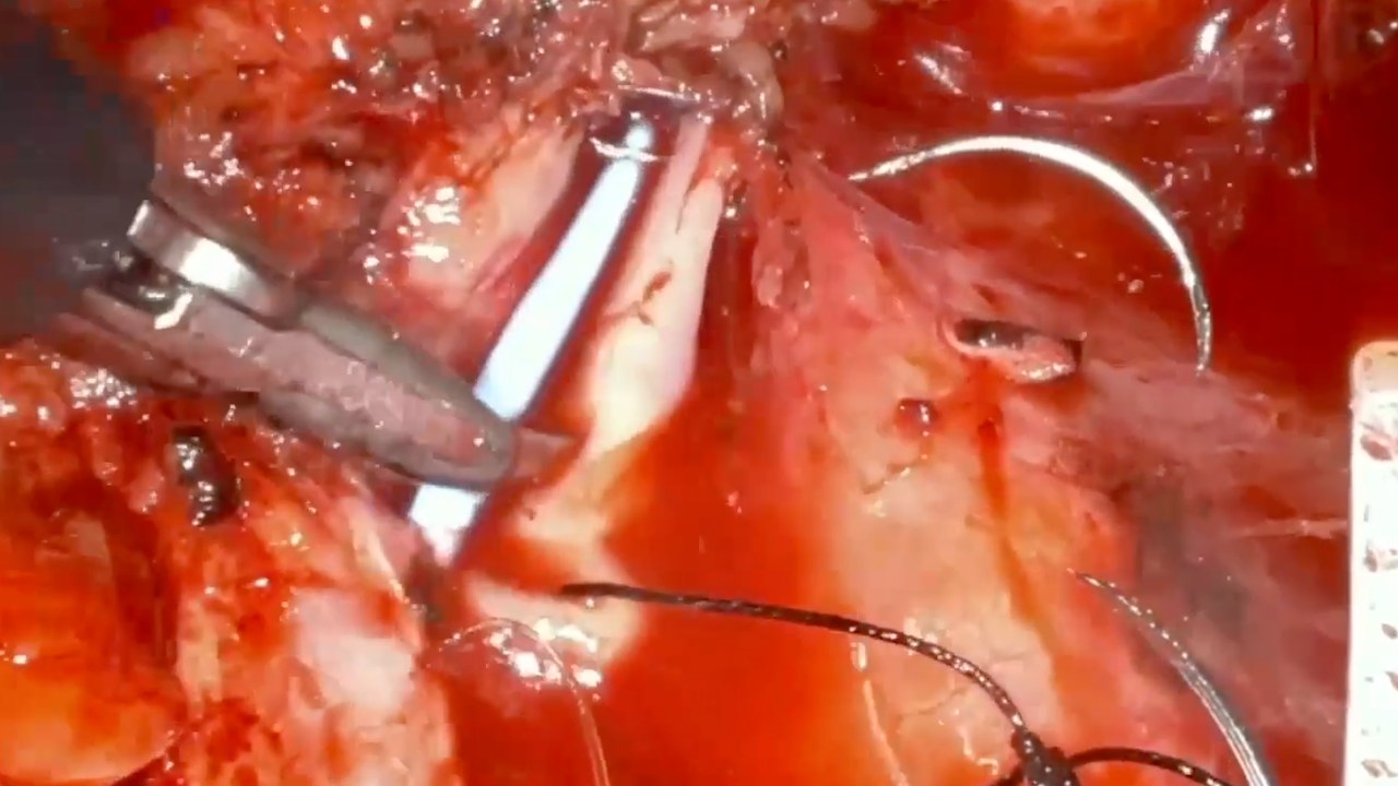 Robotic console view in red retroperitoneal tissue: a grasper at the left holds a pale strip of tissue along the opened ureter while a curved needle with dark suture works at the right.