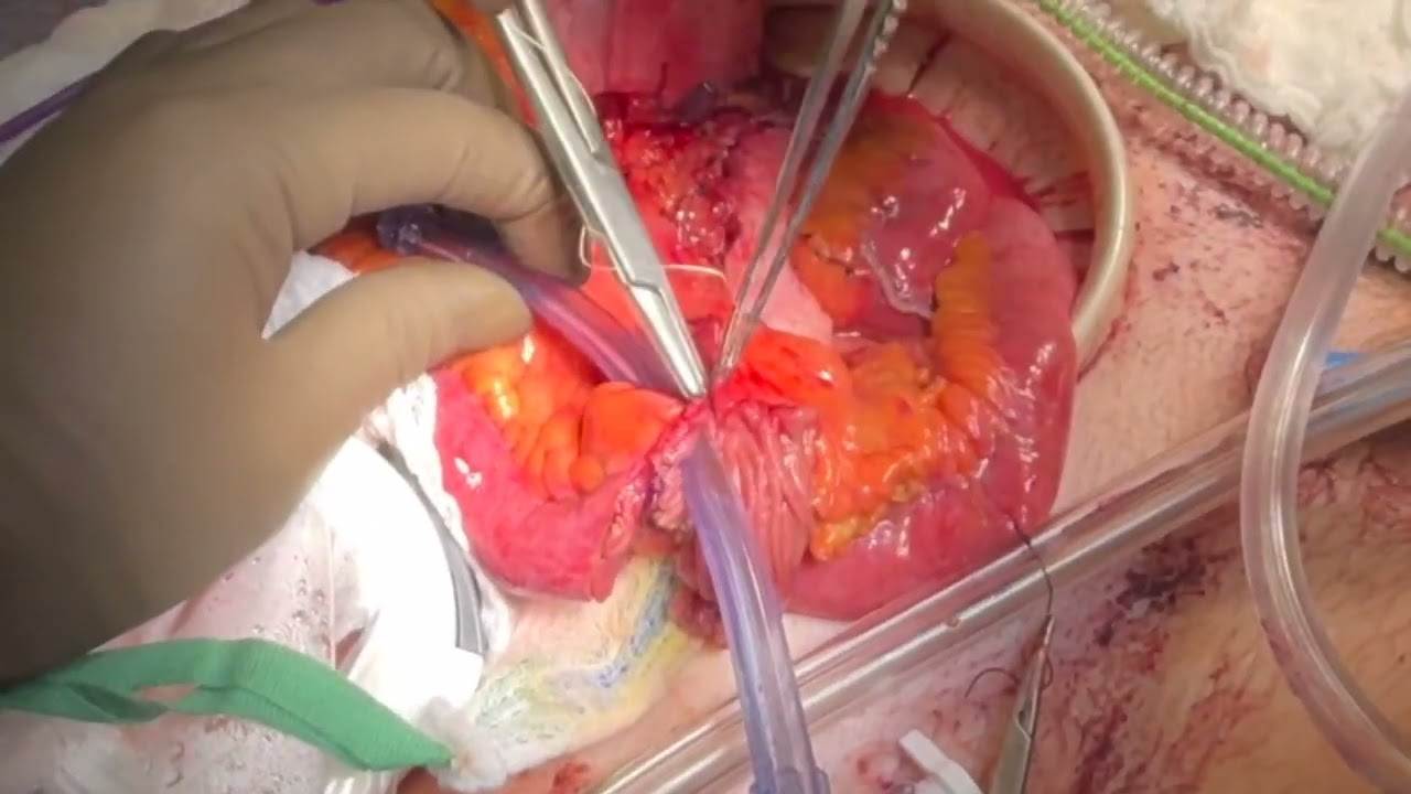 Gloved hand holding a segment of small bowel on its mesentery over a clear tube, a needle driver passing a suture through the bowel edge.