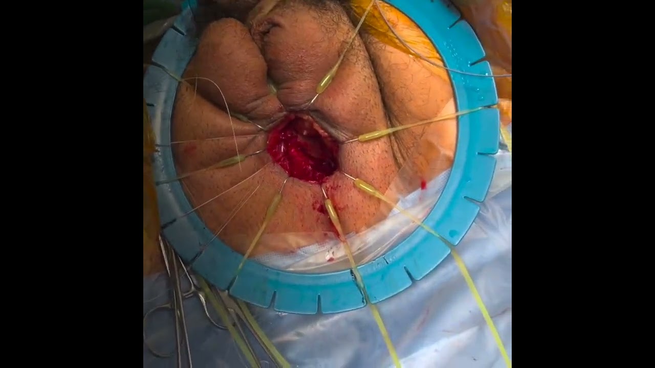 Perineal operative field seen from above through a blue ring retractor, elastic stay hooks fanning out from the opened urethra, instruments at the lower left. Portrait frame with black bars either side.
