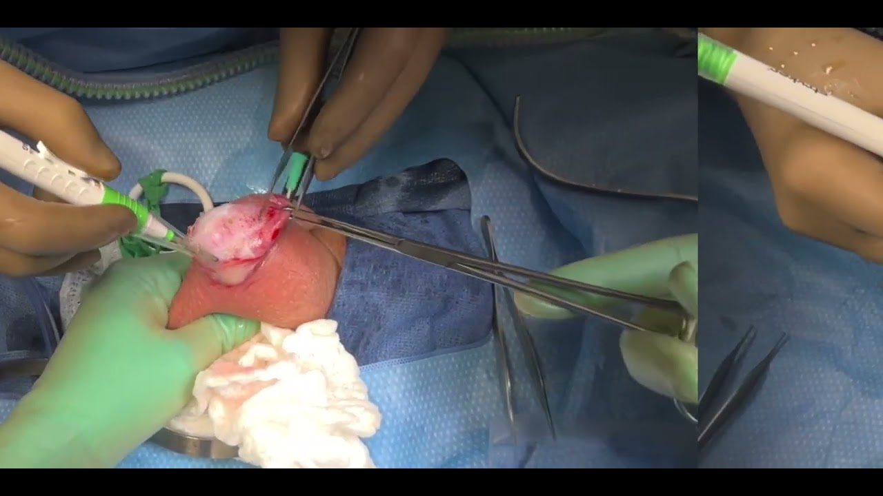 Hemiscrotum delivered through a small incision over blue drapes, one gloved hand steadying it, forceps and electrocautery working at the sac.